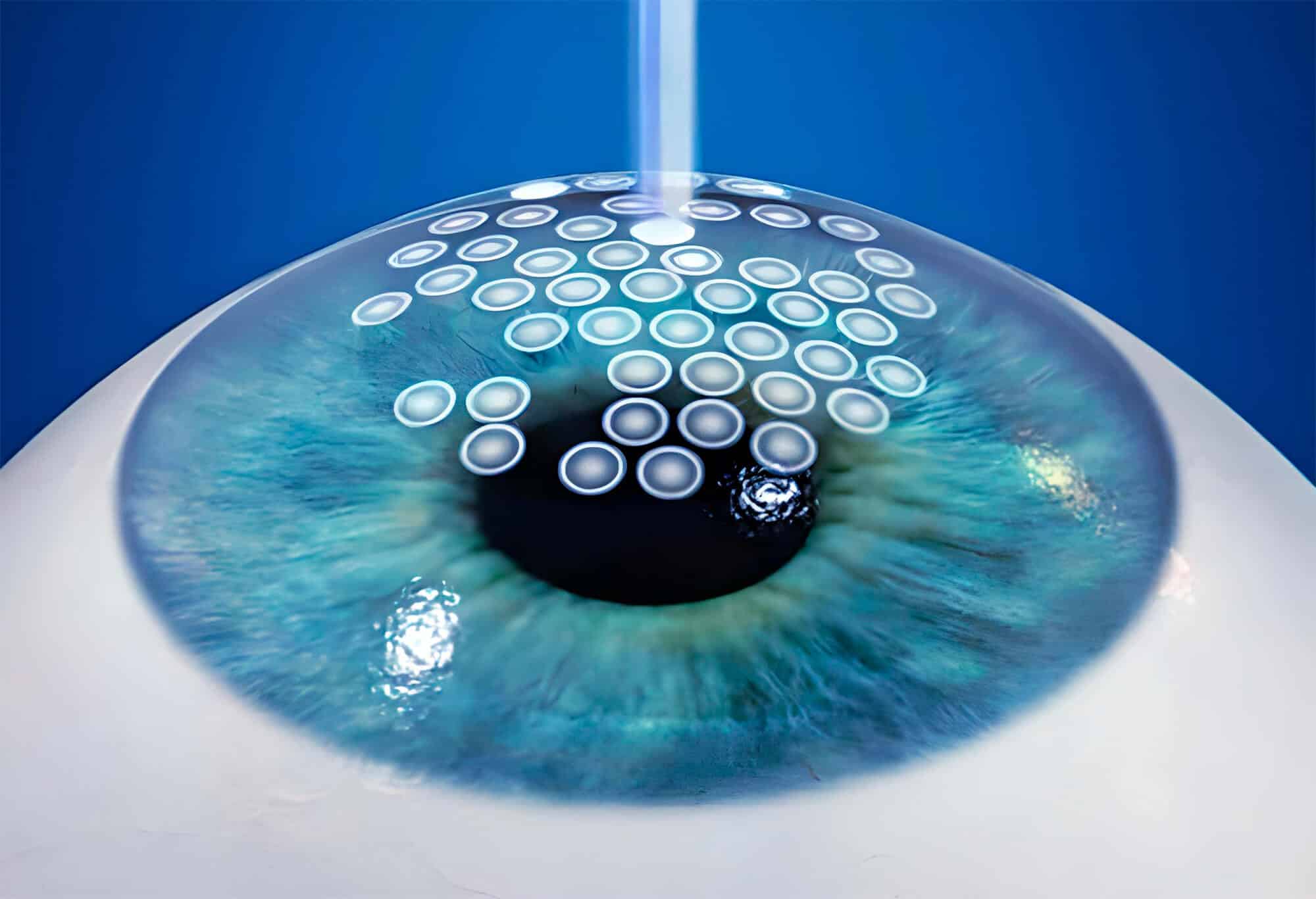 Laser vision correction procedures showing advanced corneal reshaping for clear vision without glasses.