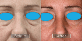 Endolift procedure