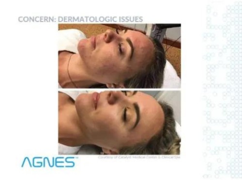 Non-Surgical Face Lift
