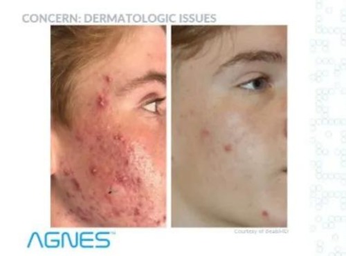 Non-Surgical Face Lift