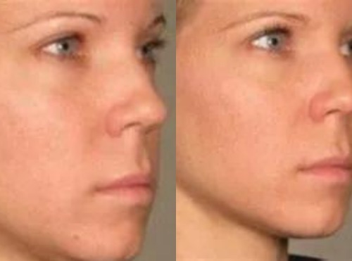 Non-Surgical Face Lift