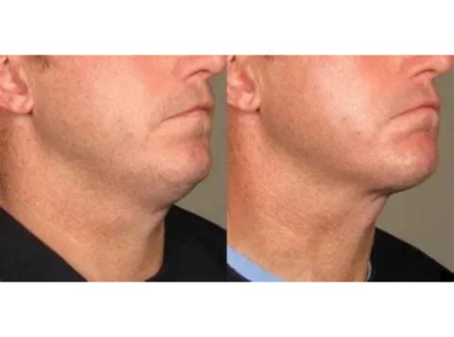 Non-Surgical Face Lift