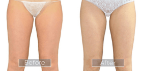 Endolift procedure