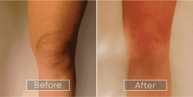 Endolift Before and After