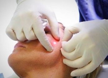 Endolaser lift treatment