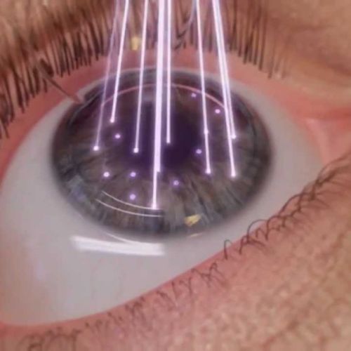 Untitled design 35 Laser Vision Correction