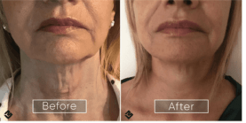 Endolift Before and After
