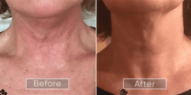 Endolift procedure