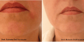 Endolift procedure
