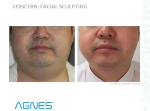 Non-Surgical Face Lift