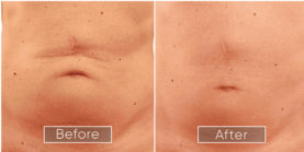 Endolift procedure