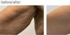 Endolift procedure
