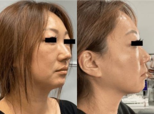Non Surgical Face Lift Before and After