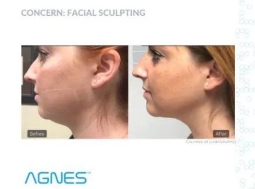 Non-Surgical Face Lift