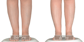 Endolift procedure