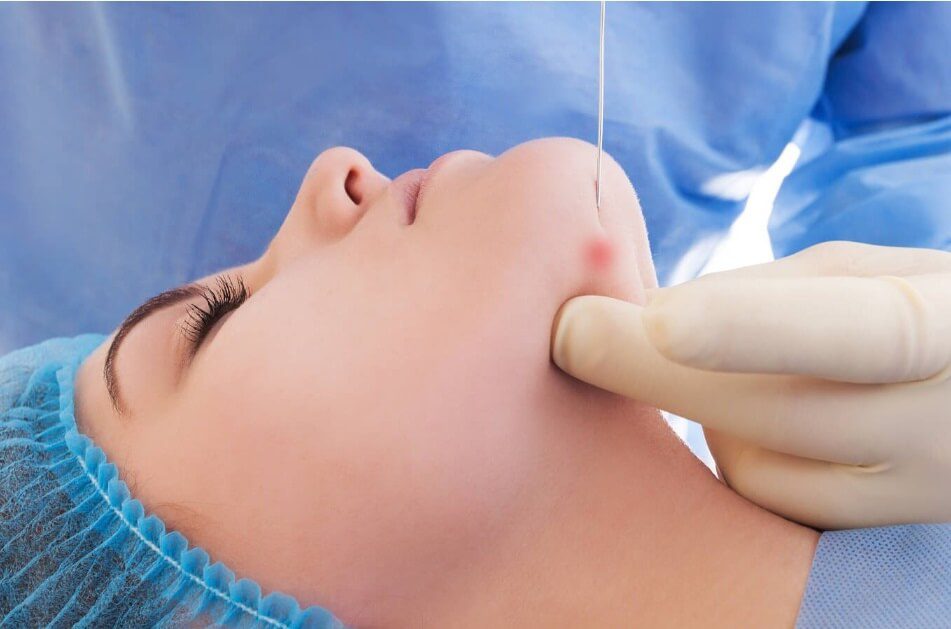 Endolift treatment