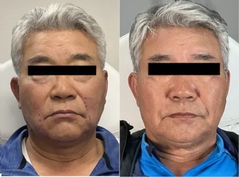 Non-Surgical Face Lift