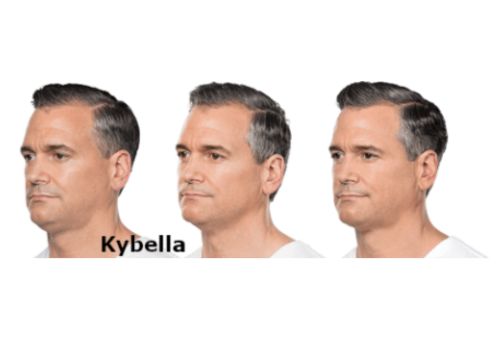 Untitled design 1 Injectables