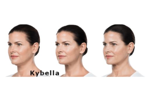 Untitled design 2 Injectables