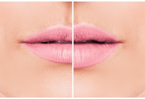 pinklipweb Injectables