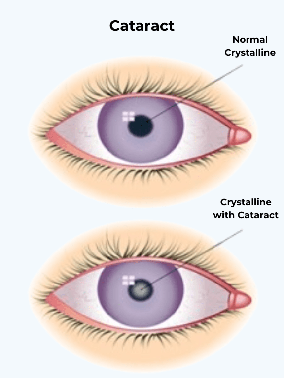 Norman Crystalline 1 Cataract Surgery