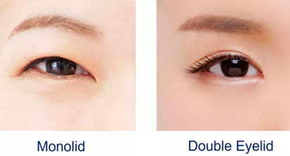 Double eye lid surgery