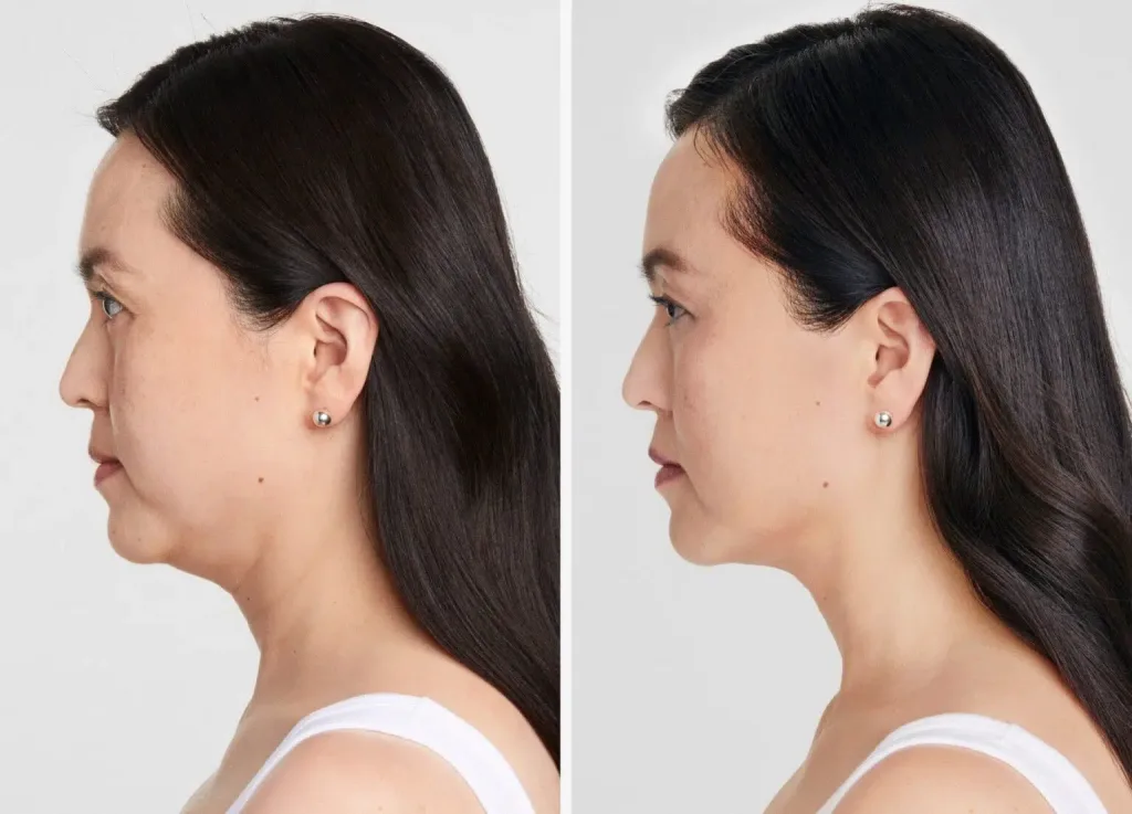 RS Decolletager Header 1536x1106.jpg Ultherapy