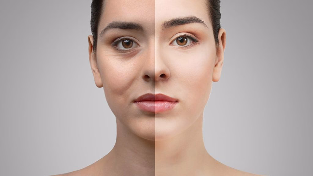 Eyelid surgery blepharoplasty