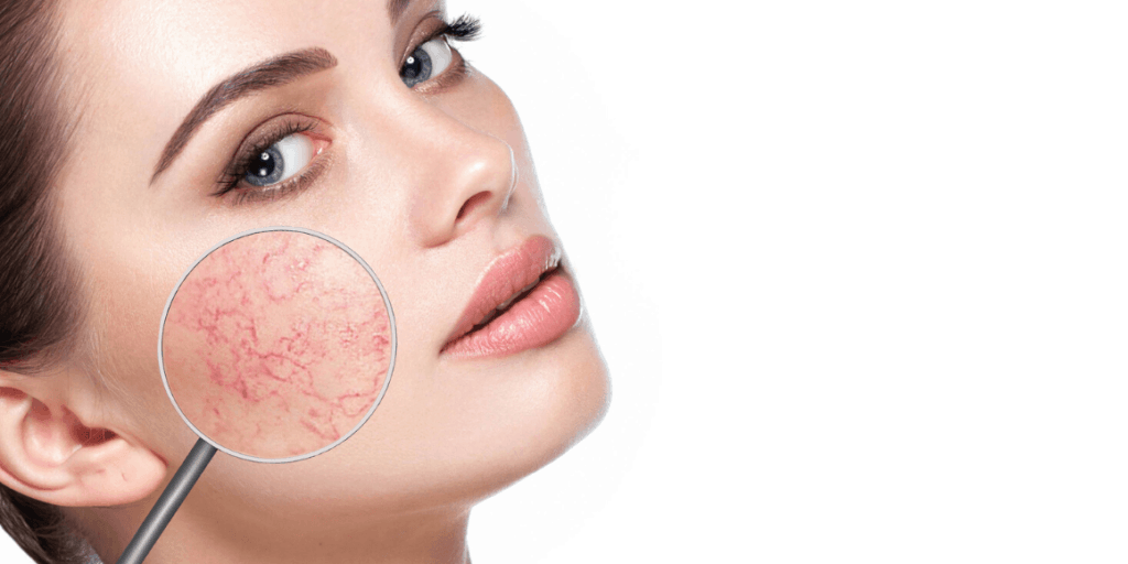 Untitled design 48 1024x512 1 Spider veins on face treatment