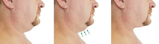 Weight loss injections7 jpg Weight loss injections