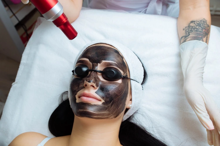 carbon laser peel 1 Carbon laser facial