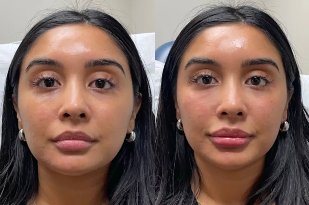 dermal fillers 683 front detail Dermal Fillers