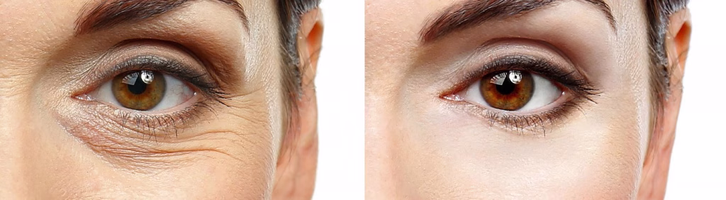 dermal fillers banner Under eye filler