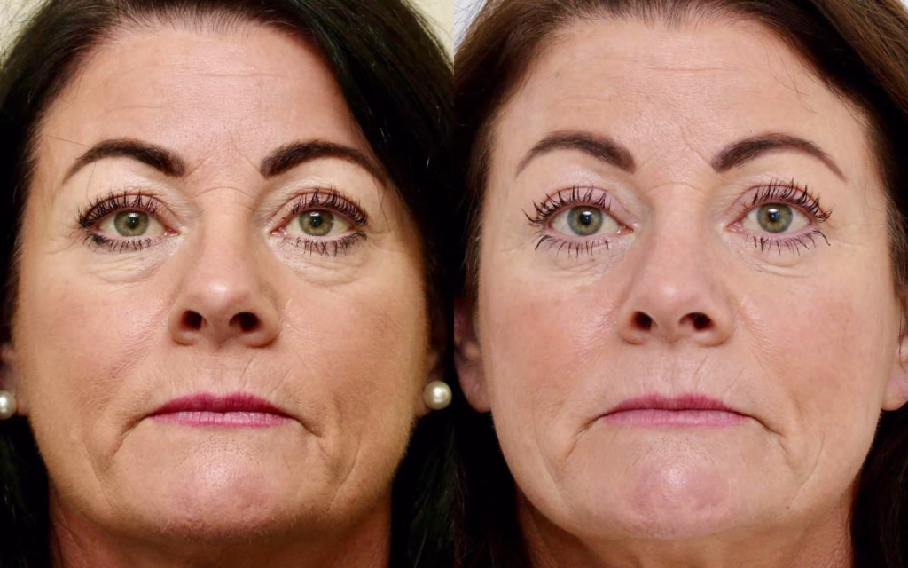 Upper and Lower blepharoplasty