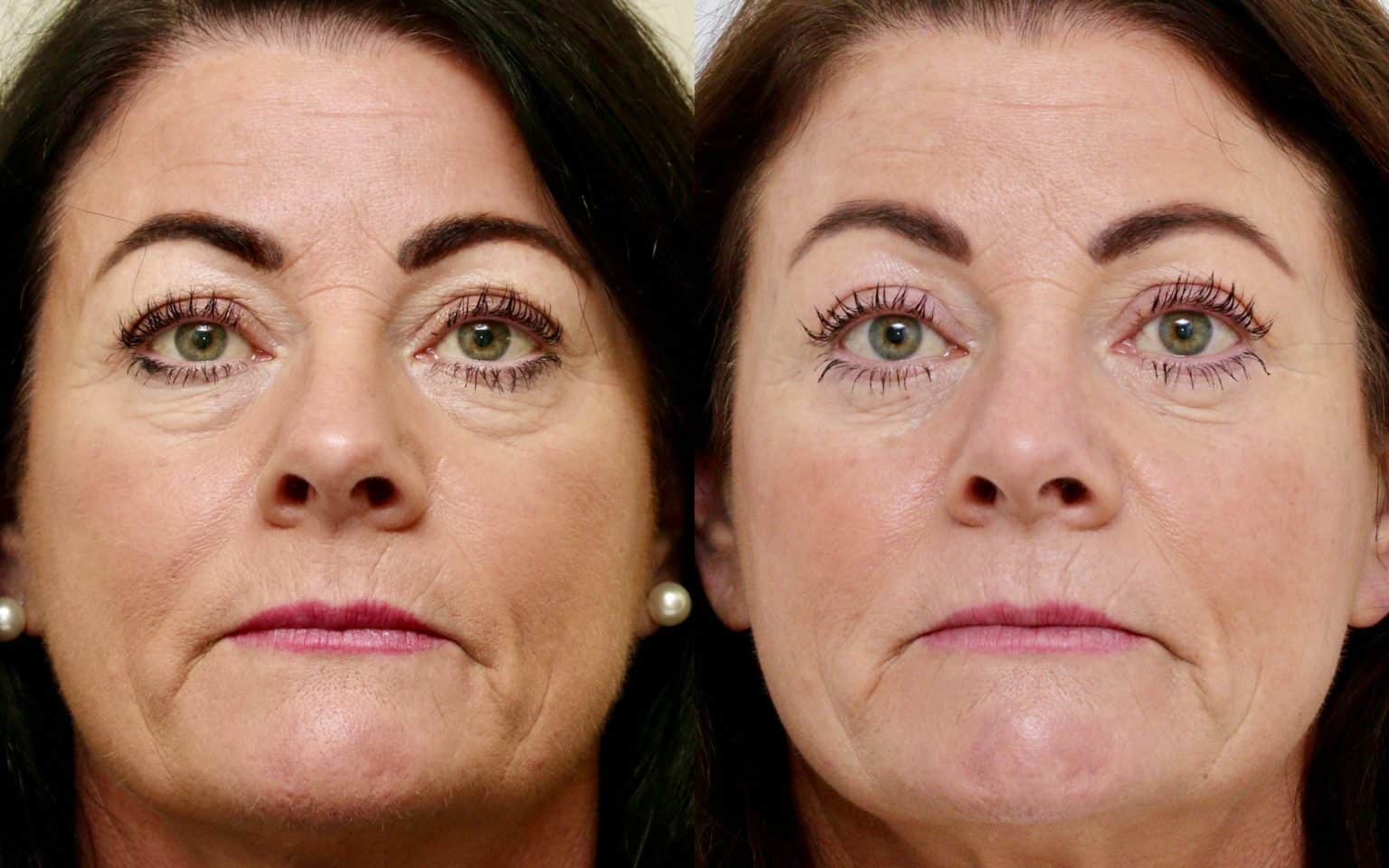 Upper and Lower blepharoplasty