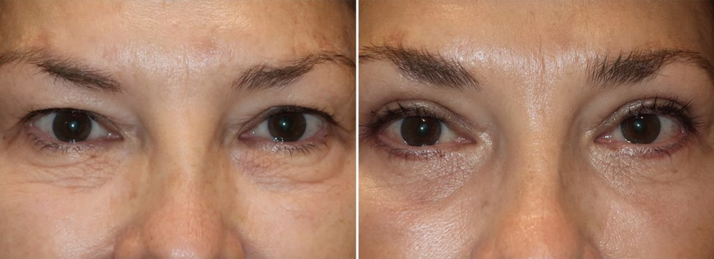 173 Upper and Lower blepharoplasty
