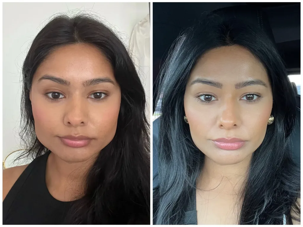 2 1 Masseter botox near me