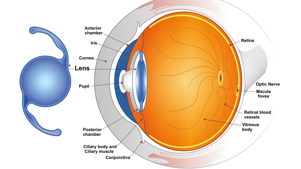 3333 What Are Multifocal Intraocular Lenses (IOLs)?