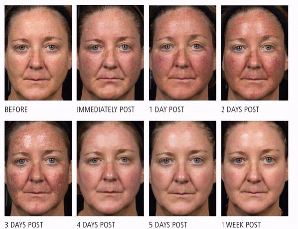 45335 jpg Fraxel Laser Skin Resurfacing