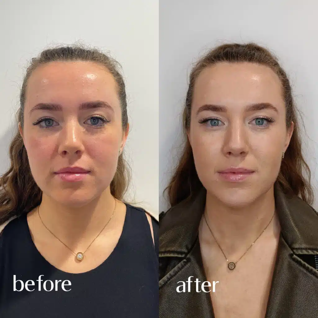 45678 botox-injections