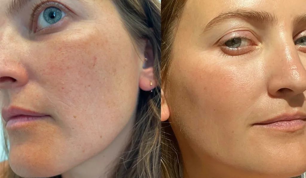 47edj Broken blood vessels on face