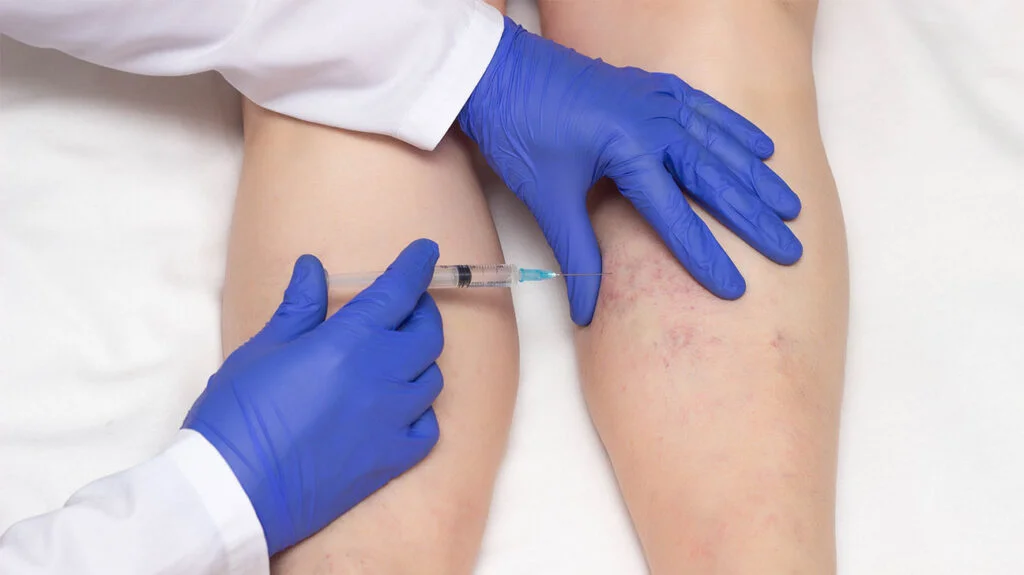 65 Sclerotherapy