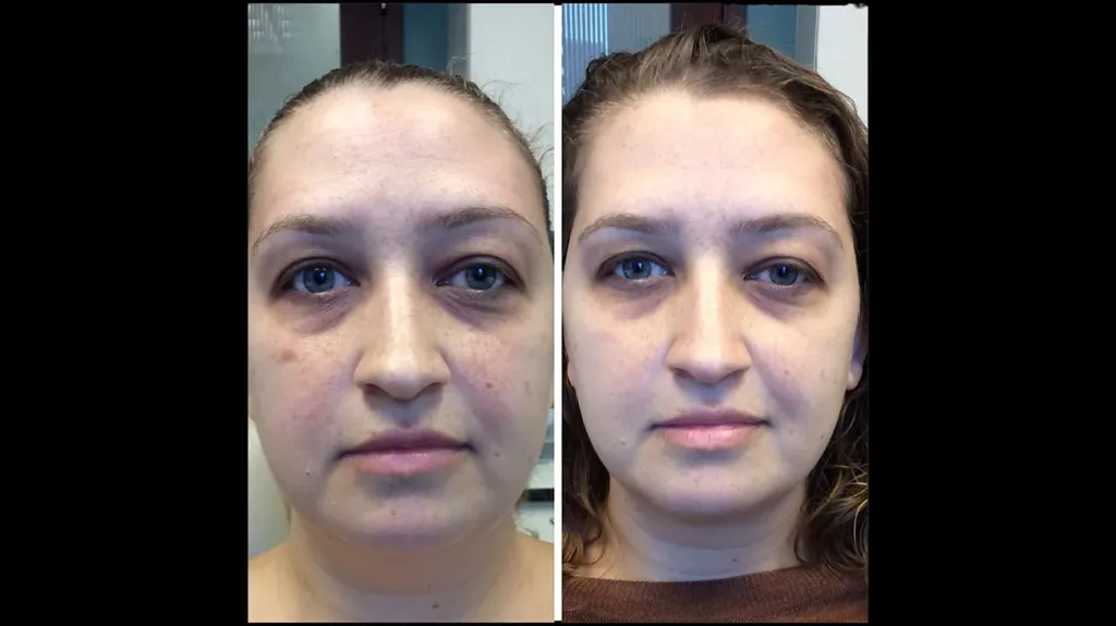 6543 Fraxel Laser Skin Resurfacing