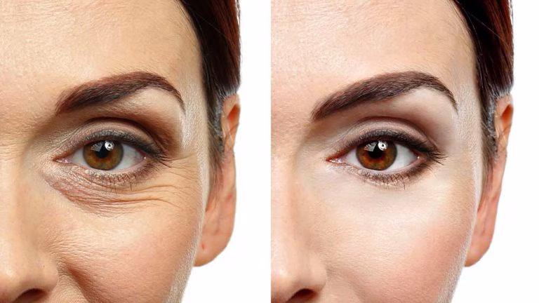 78576 jpg Under Eye Skin Tightening Laser
