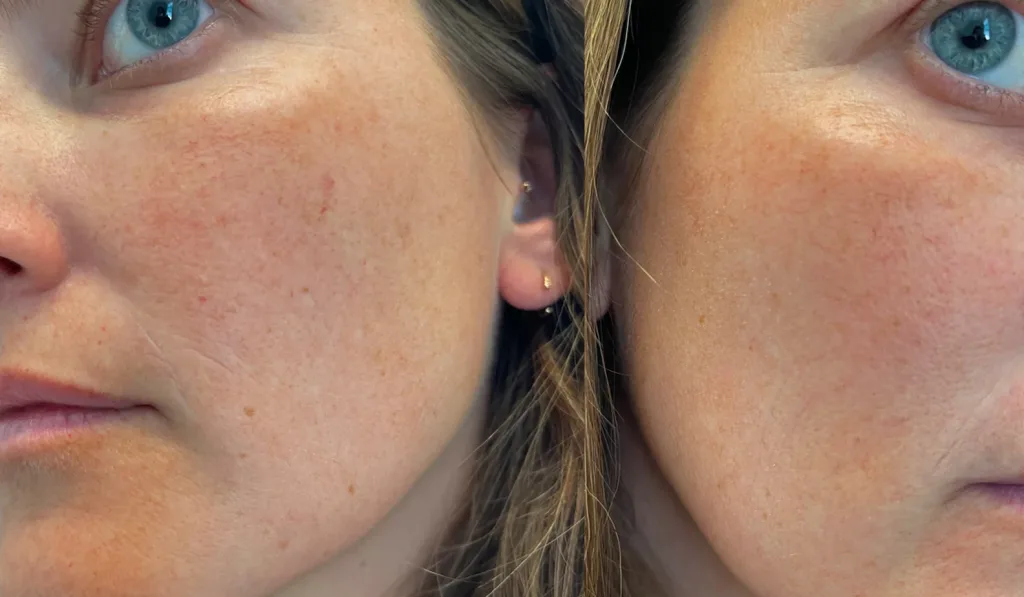 7894irke Broken blood vessels on face