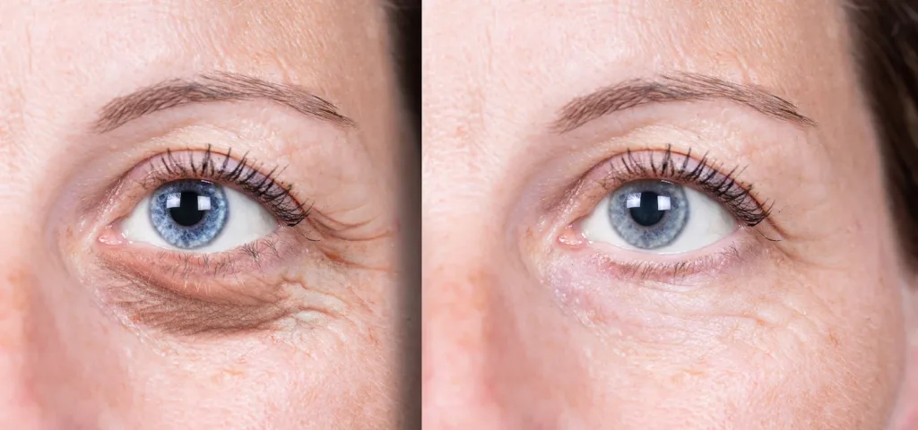 8769766 Under Eye Skin Tightening Laser