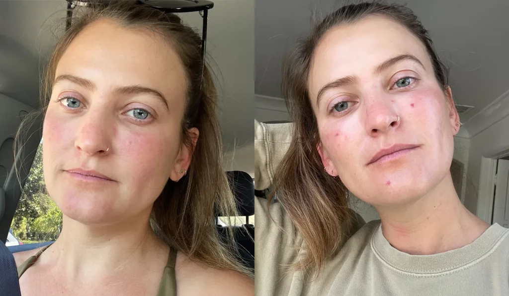 87iu6ytrewsz Broken blood vessels on face