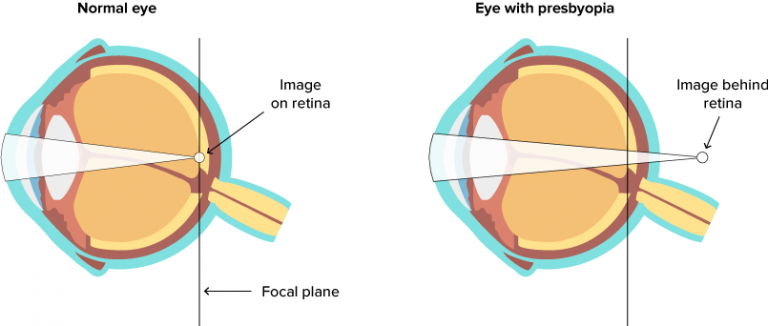 8944 Presbyopia correction surgery