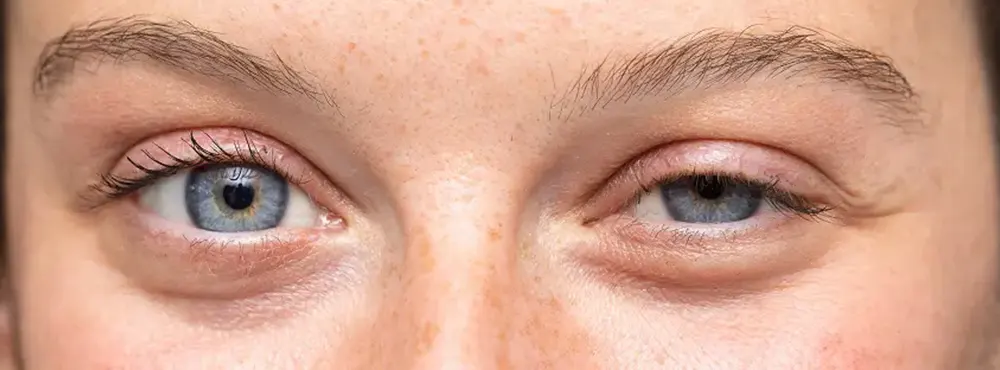 droopy eyelids ptosis–causes and treatments 2 Eye Drops for Droopy Eyelids