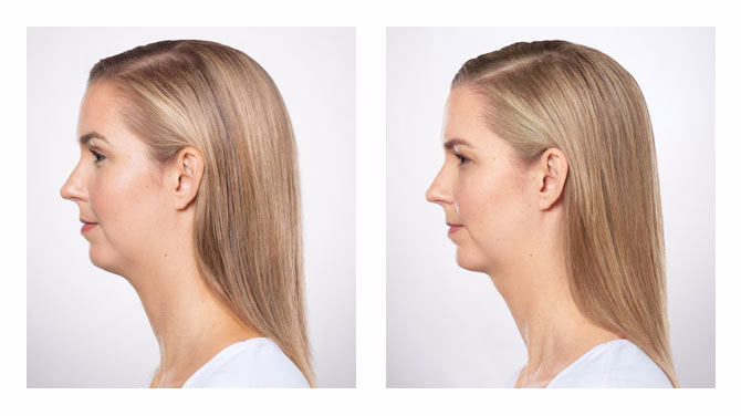 kybella ba 1 jpg kybella ba 1 jpg